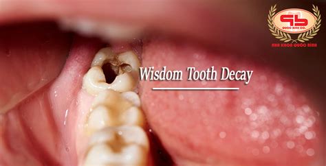 In some cases the hole may be the size of an entire molar. What to do when having a wisdom tooth decay?