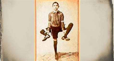 Frank Lentini The Three Legged Sideshow Performer With Two Penises