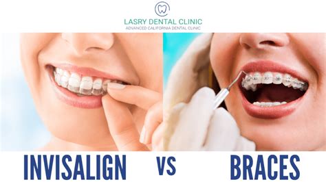 Invisalign Vs Braces Which One Should You Choose