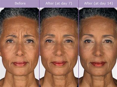 Botox Before And After Photos Lounge Of Beauty Medical Spa Medical Spa