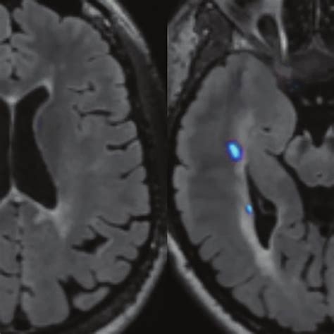 Dynamic Lesion Segmentation Of Multiple Sclerosis Plaques In This