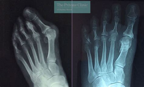 Bunion Surgery Before After Photos Uk 2023 Before And After Pictures