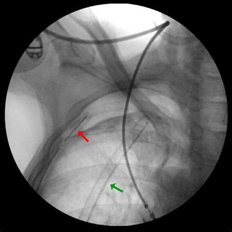 -Fluoroscopy-guided thoracostomy shows a 4-sized French catheter (Blue ...