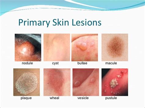 Skin Lesions Skin Disorders Skin Pediatric Nursing