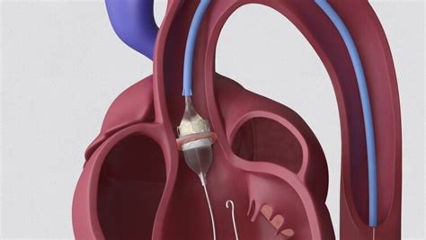 Transcatheter Aortic Valve Implantation Tavi Explain My Procedure