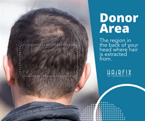 Factors That Make You A Good Hair Transplant Candidate