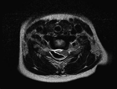 Mri T2 Weighted Axial Scan Shows Cord Compressed And Displaced To The