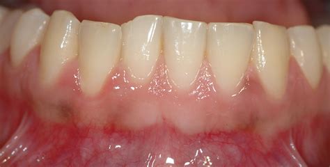 Home Treatment For Sore Gums General Center