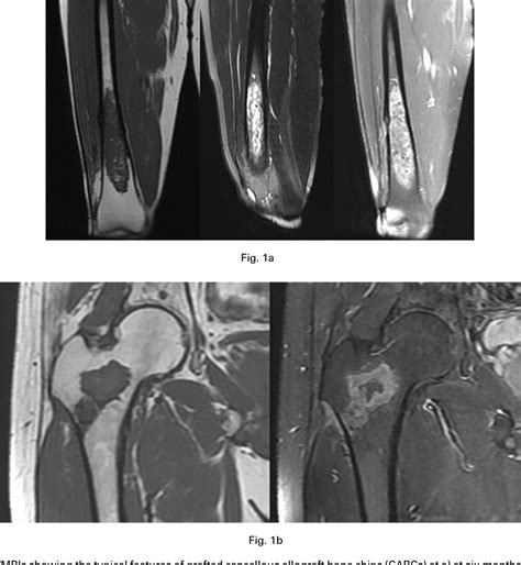Figure 1 From The Mri Appearances Of Cancellous Allograft Bone Chips