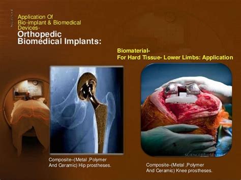 Application Of Bio Implant And Biomedical Devices Recent Advancement A