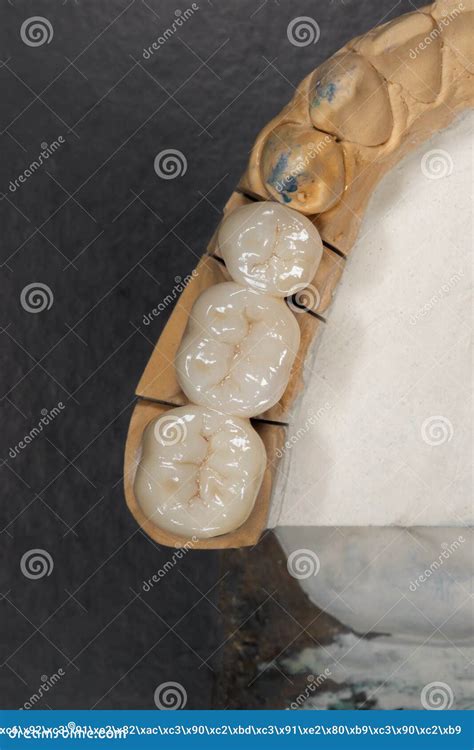 Ceramic Tooth Crowns And Metal Pins Close Up Macro Orthopedic