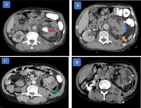 Abdominal Ct Scan Oral And Intravenous Contrast Material A B C