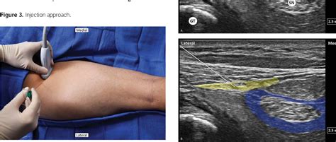 Ultrasound‐guided Posterior Femoral Cutaneous Nerve Block A Cadaveric