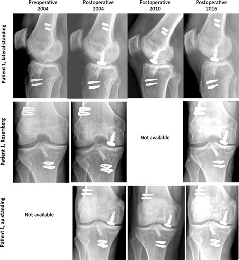 Radiographic Follow Up Of Patient 1 At Different Time Points Download