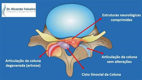 Cisto Sinovial De Coluna Lombar O Que E Como Tratar Ortopedista Em