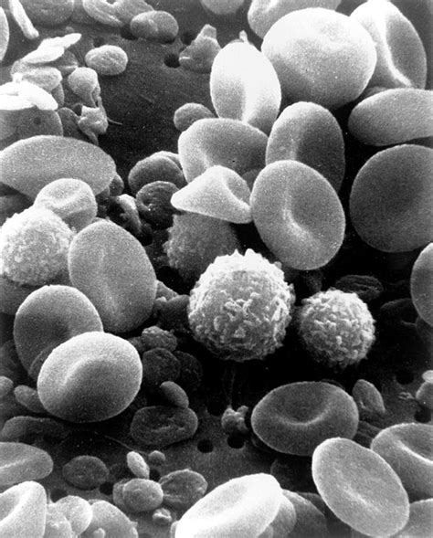 Quantitative White Blood Cell Disorders Types And Presentation
