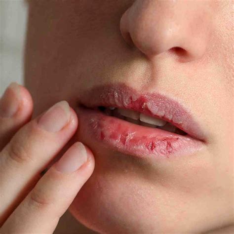 Get Rid Of Chapped Lips Home Remedies