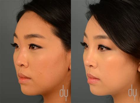 Injectable fillers , botox® cosmetic , and fat grafting all can be used to deliver nonsurgical improvement of the nose, brow, upper and lower eyelids, jawline. Asian Nose Augmentation - Sexy Fucking Images