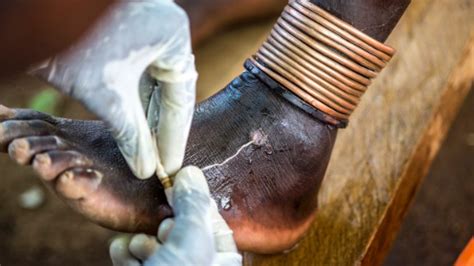 South Sudan Goes 15 Months Without A Case Of Guinea Worm Cnn