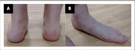 Foot Deformity In Mfs A Mild Valgus Hindfoot Deformity Of Left Foot Download Scientific