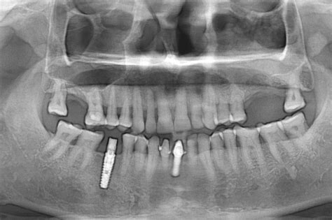 Sinus Graft Ahmedabad Sinus Lift India Implantologist Gujarat