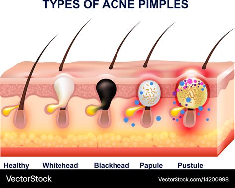 Skin Acne Anatomy Composition Royalty Free Vector Image