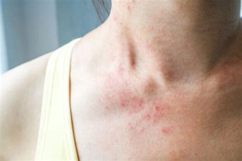 Rash On Neck Meaning Causes Itchy Red Bumpy Rash
