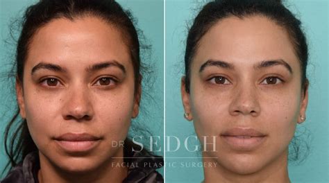 Buccal Fat Reduction Before And After Photos Dr Sedgh