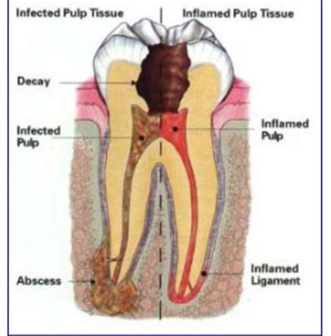 One reason that this may occur is because when a person is lying down, blood this extra blood in the area may increase the pain and pressure that people feel from a toothache. Temporary Emergency Cavity Toothache Relief Until Dentist ...