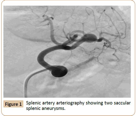 Stent Assisted Detachable Coil Embolization Of Two Splenic Artery