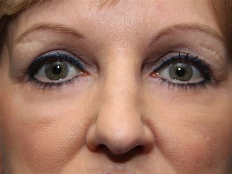 LASER RESURFACING - Solomon Facial Plastic