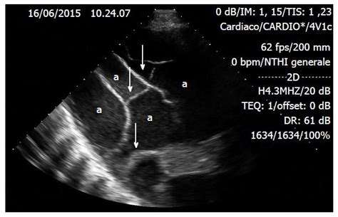 Lactic acid dehydrogenase (ldh) 2.2.1. Incremental value of thoracic ultrasound in intensive care units: Indications, uses, and ...