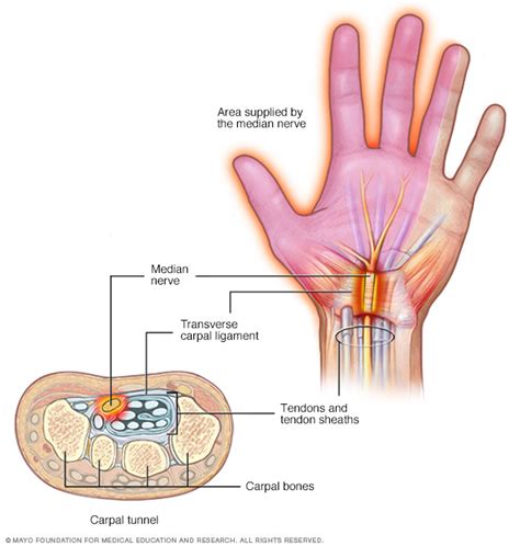 Pinched Nerve Disease Reference Guide
