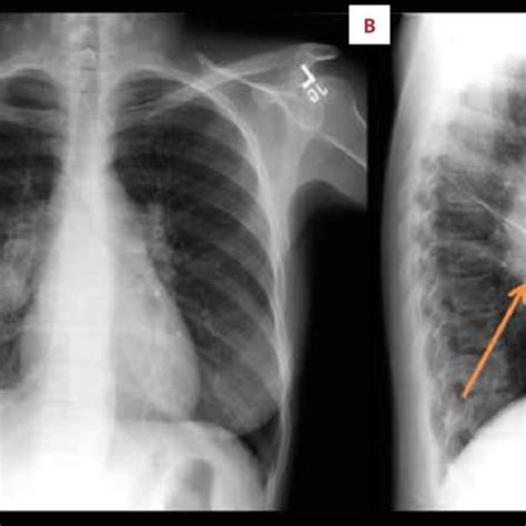 Chest X Ray At Presentation A Frontal View Right Hilar Arrow