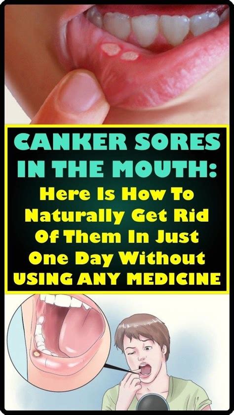 One Of The Most Common Oral Fitness Issues Is A Canker Sore Or An