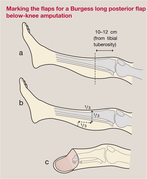 Lower Limb Amputation And Rehabilitation Surgery Oxford