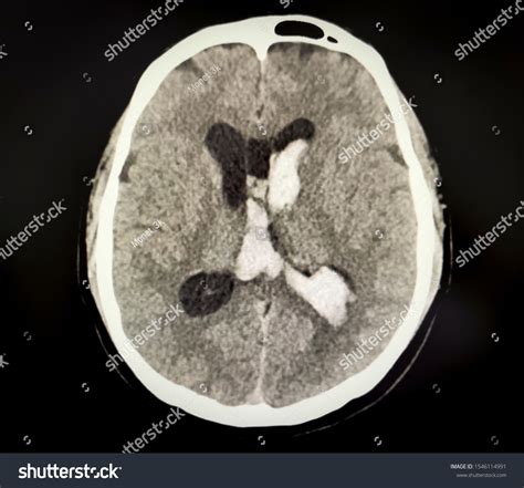 Image Ct Scan Showing Intraventricular Hemorrhage ภาพสต็อก 1546114991