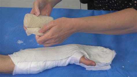Applying A Cast In The Position Of Safe Immobilisation Youtube