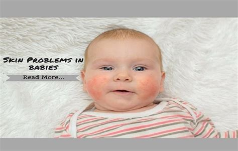 Skin Rashes In Babies