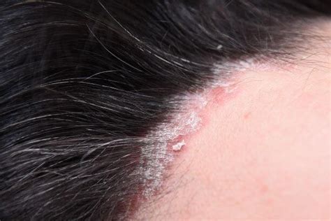What Does Scalp Psoriasis Look Like Us Dermatology Partners