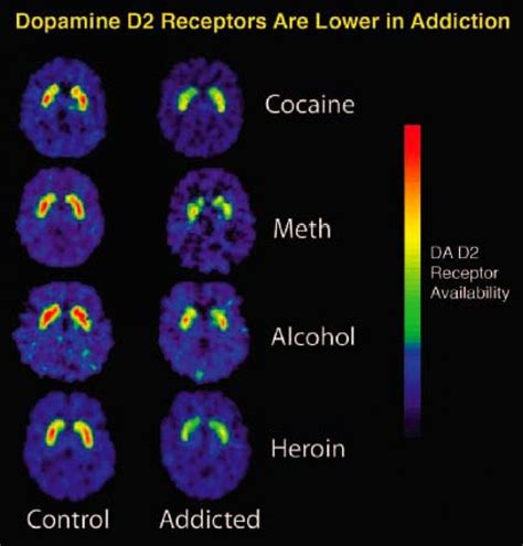 The Influence Of Addictive Substances On Brain Abuse