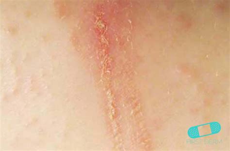 Dermatitis De Contacto Guía De La Piel Dermatólogo En Línea