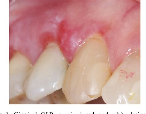 Figure 1 From The Gingival Oral Lichen Planus A Periodontal Oral