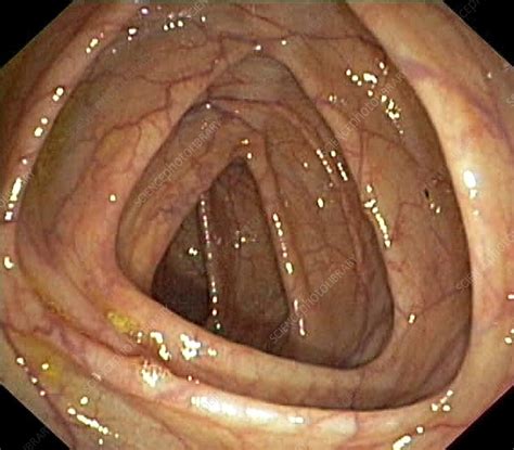Most colon polyps are harmless. Healthy colon - Stock Image - C010/3767 - Science Photo ...
