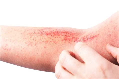 Dermatite cosè e come si cura