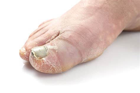 Sick Nail On The Foot Toenail Fungus Isolated On White Sore Toenail