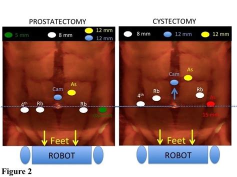 Port Placement Comparison For Robotic Radical Cystectomy As Assistant Download Scientific