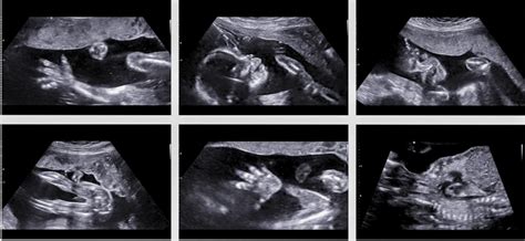 20 Weeks Pregnant 3d Ultrasound
