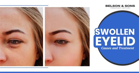 Swollen Eyelid Symptoms Causes And Treatment Belson Opticians