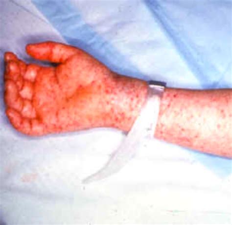 Rocky Mountain Spotted Fever Concise Medical Knowledge